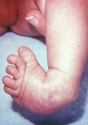 beba rođenih, displazija kuka, displazije kuka, javljaju tijekom, kuka može, može liječiti