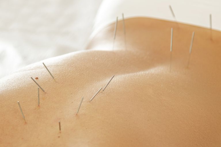 akupunktura koristi, akupunktura može, ljude rakom, može pomoći, pacijente rakom, protiv boli