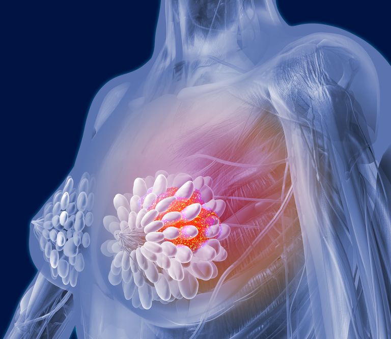 raka dojke, vrsta raka, Angiosarkom grudi, vrsta raka dojke, angiosarkom dijagnosticiran