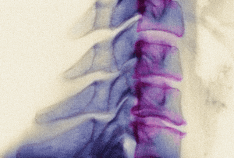 artritis vrata, cervikalnu spondilozu, može pomoći, artritis vratu