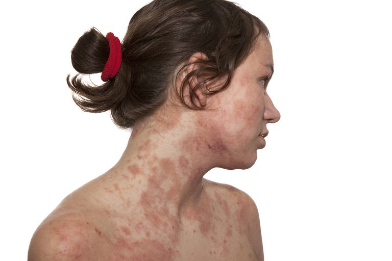 Atopijski dermatitis, atopijskog dermatitisa, koža pretjerano, koža pretjerano osjetljiva, pretjerano osjetljiva