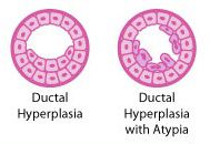 duktalna hiperplazija, karcinoma dojke, raka dojke, Atipična duktalna, atipične duktalne, atipične duktalne hiperplazije