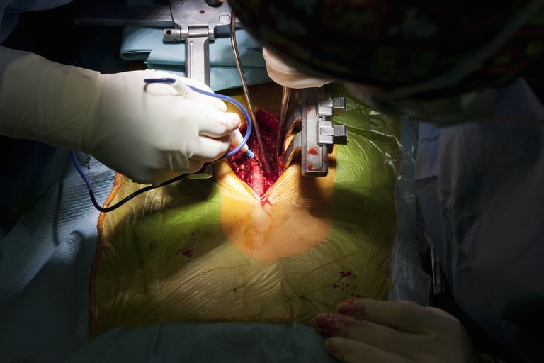 kirurški zahvat, može biti, morbidno pretilih, operacije leđa, tjelesnu težinu, akademija neurokirurga