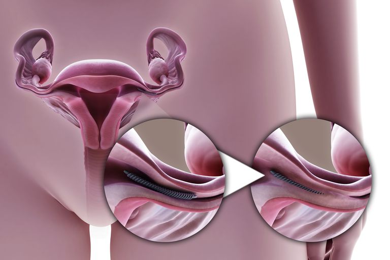 kontrole rađanja, postupak Essure, Essure postupak, jajovodne cijevi