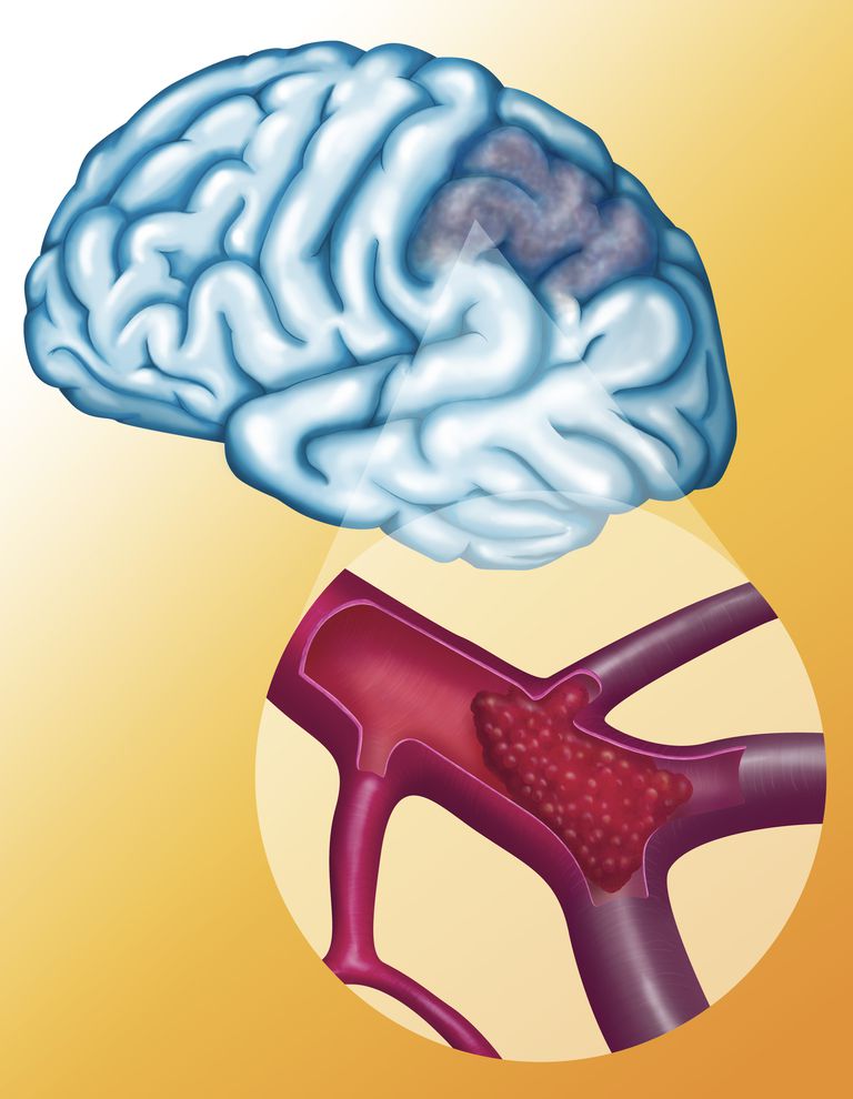 moždanog udara, nakon moždanog, nakon moždanog udara, ishemija mozga