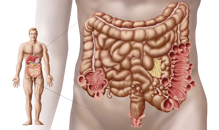 debelog crijeva, debelom crijevu, možda neće, može uzrokovati