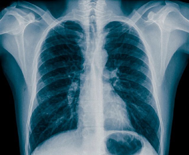 prsa X-zraka, bolesti pluća, rendgenskih zraka