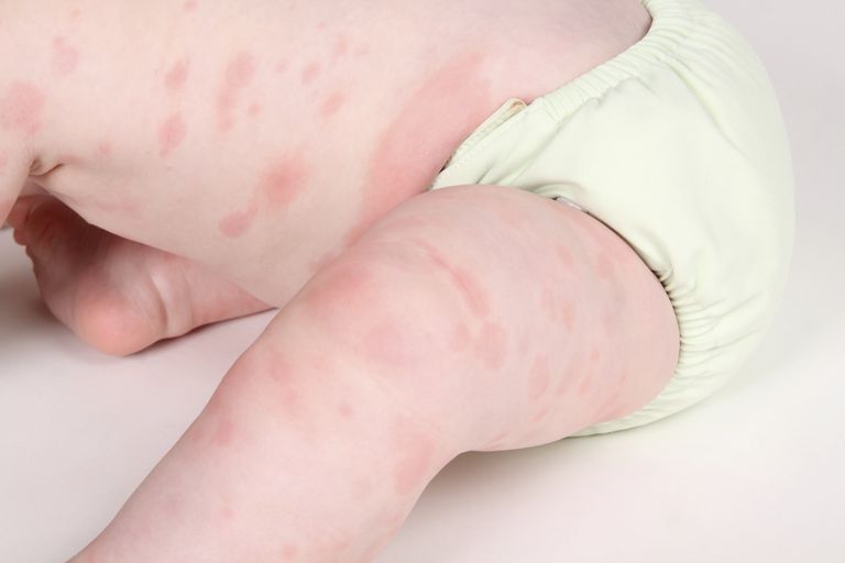 vaše dijete, alergijsku reakciju, alergijske reakcije, može biti, alergije penicilina, dijete alergično