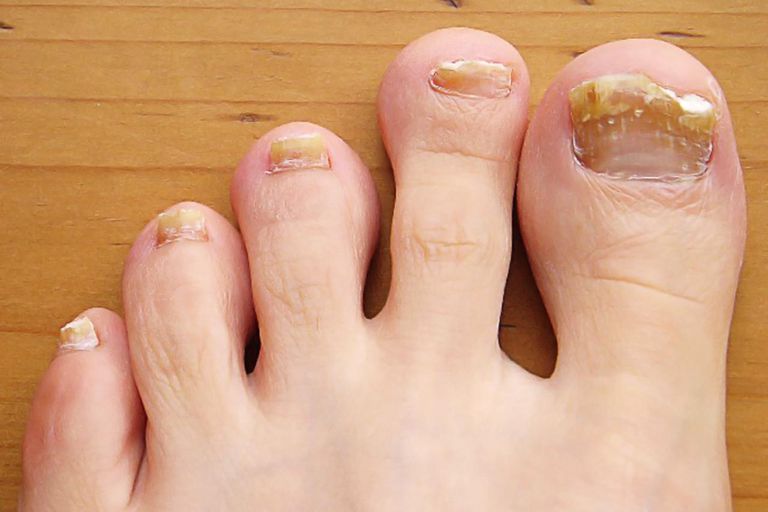 gljivične infekcije, toenail gljiva, toenail gljivične, toenail gljivične infekcije, Toenail trauma