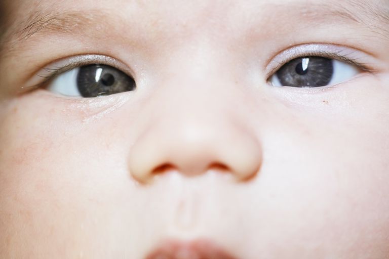 beba problema, četiri mjeseca, može pojaviti, prekriženih očiju, prema unutra, vaša beba
