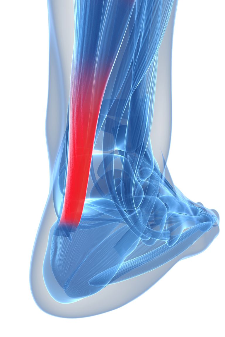 slabu točku, Ahilni tendonitis, Ahilove pete, Ahilove tetive, Ahilski tendonitis