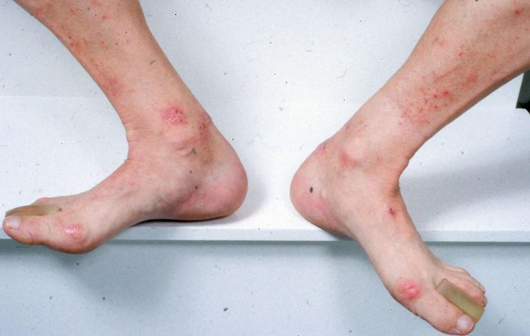 Dermatitis herpetiformis, može biti