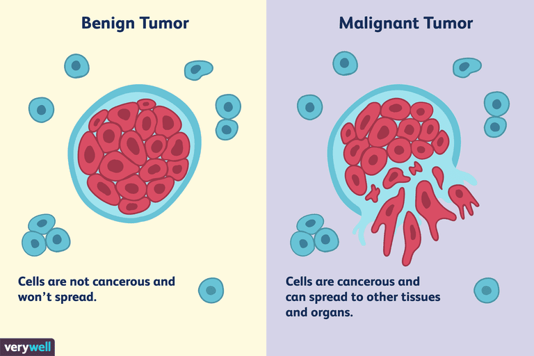 tumori mogu, benignih tumora, Maligni tumori, Maligni tumori mogu, raka dojke