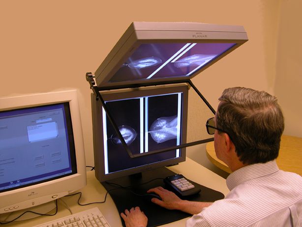 digitalna mamografija, Digital Mammographic, Digital Mammographic Imaging, Imaging Screening, Imaging Screening Trial, Mammographic Imaging