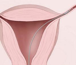 nakon postupka, postupka Essure, jajovodne cijevi, kontrole rađanja, mogu biti, postupak Essure