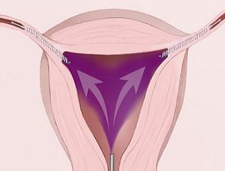 nakon postupka, postupka Essure, jajovodne cijevi, kontrole rađanja, mogu biti, postupak Essure