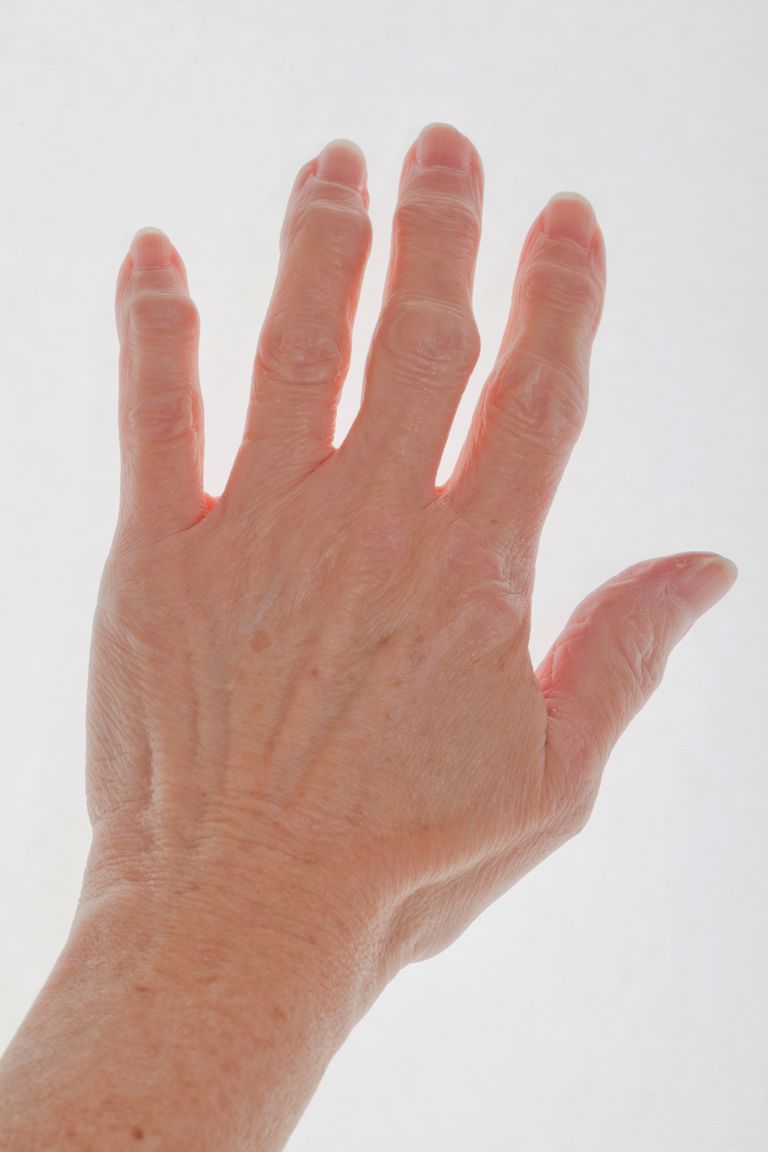 prstiju artritisa, stanje koje, artritisa također, Kada naši