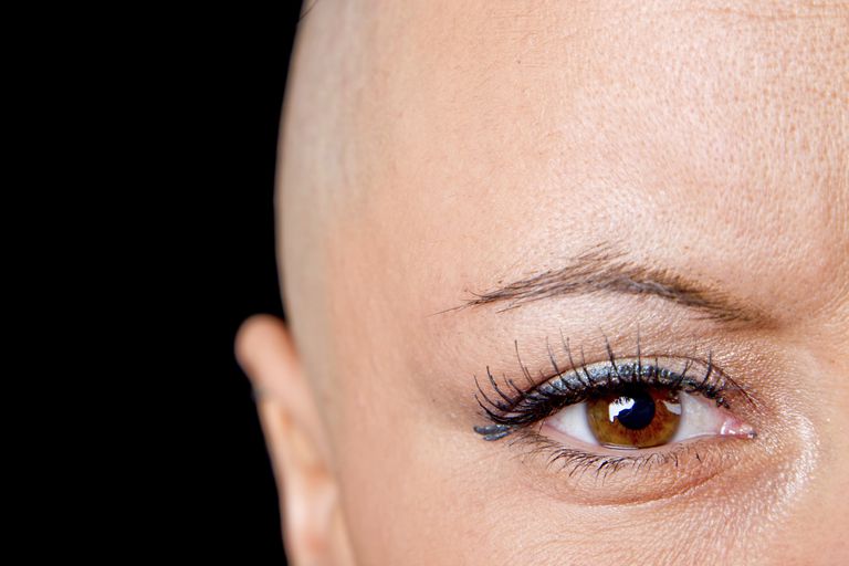 nakon kemoterapije, gubitak kose, kosa raste, stanice raka