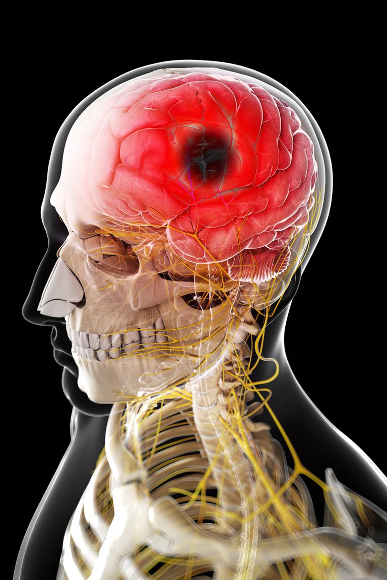 moždanog udara, moždani udar, hemoragijskog moždanog, hemoragijskog moždanog udara, krvni tlak, može biti