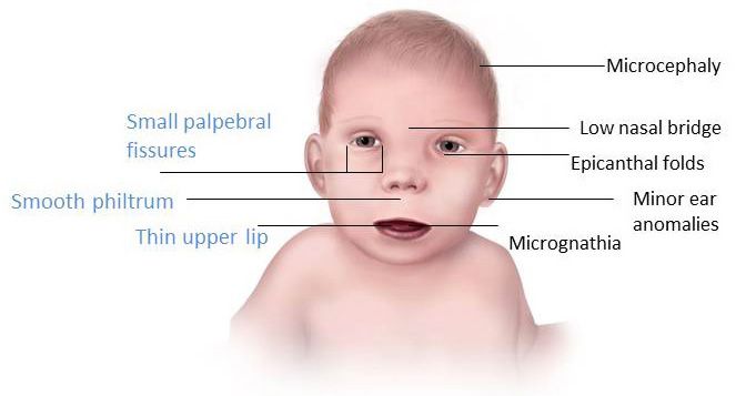gornje usne, fetalnog alkohola, kasnije životu, mogu imati, povezanih alkoholom, tijekom trudnoće