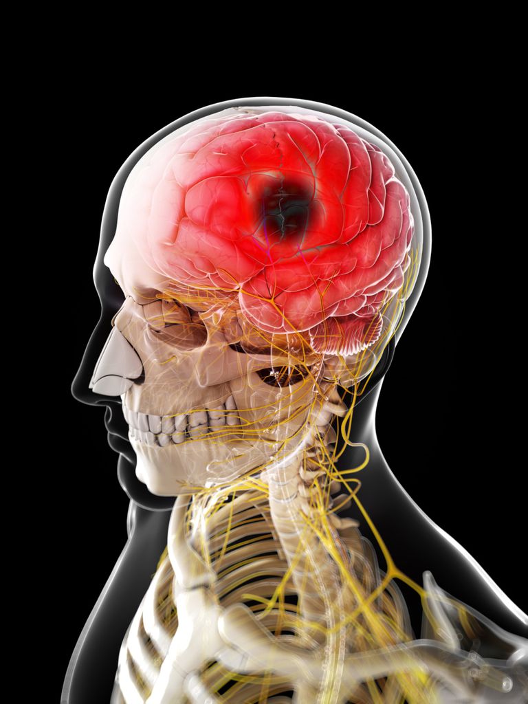 moždani udar, moždanog udara, nastaje kada, jaka glavobolja, kada arterija, moždani udar nastaje