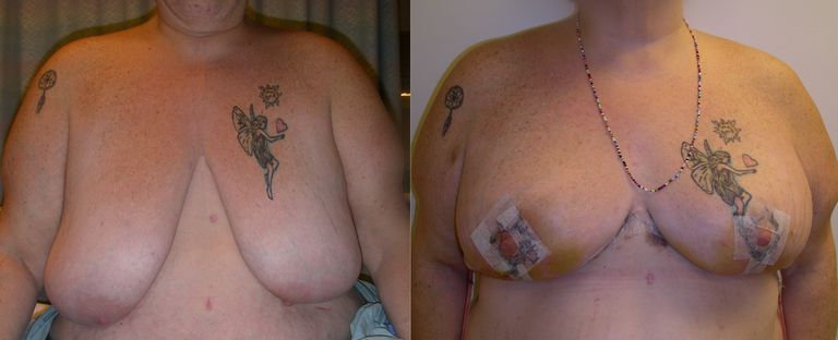 granice areole, podizanje grudi, prije operacije, oblik dojke