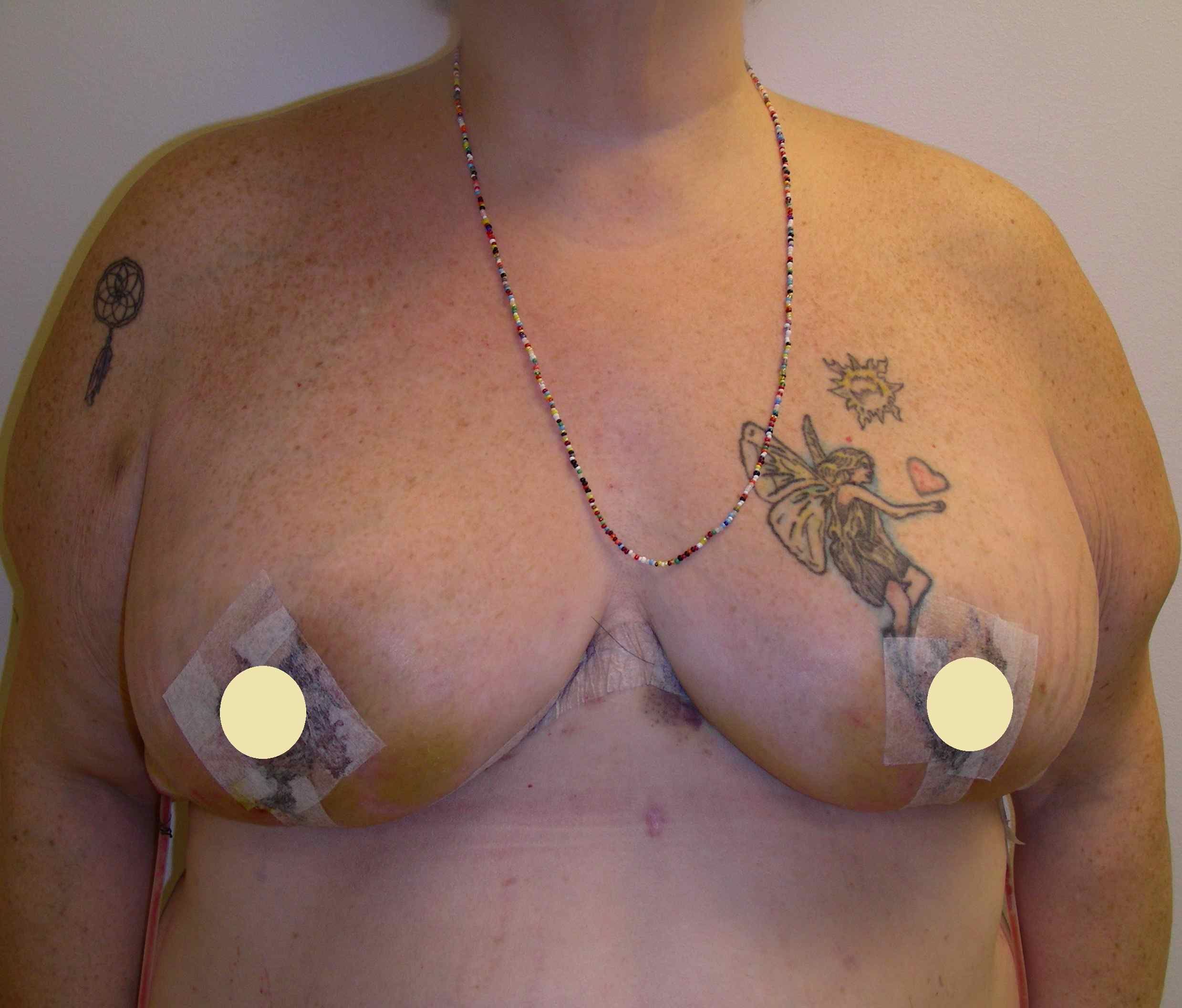 granice areole, podizanje grudi, prije operacije, oblik dojke