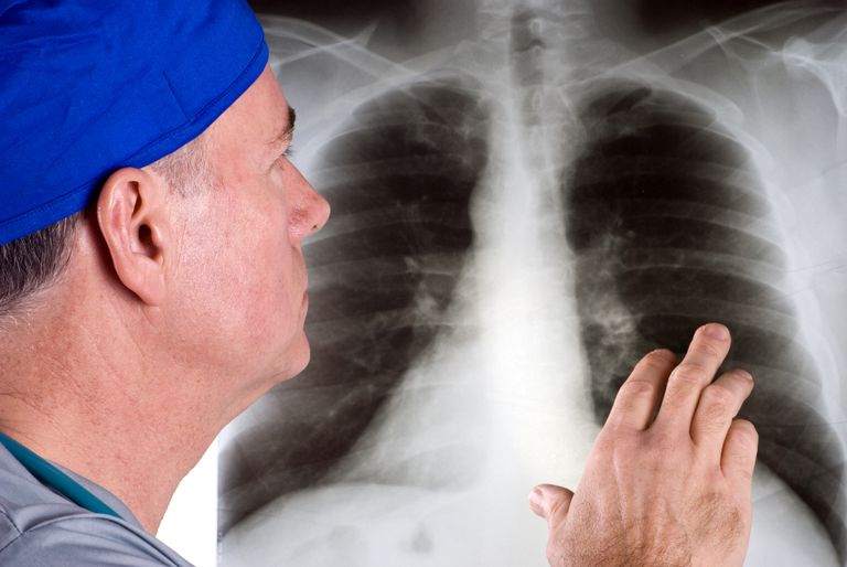 raka pluća, pluća može, tumore koji, stanicama raka, između pluća, karcinoma pluća