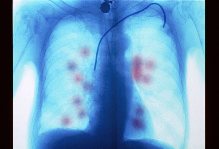 metastaza pluća, metastazama pluća, raka pluća, metastaze pluća, proširio pluća