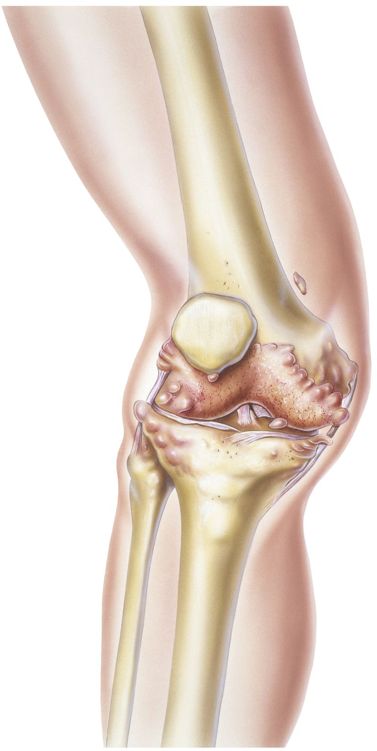 vrsta zgloba, bilo koji, Reumatoidni artritis, vrsta zgloba omogućuje, zglob vrsta