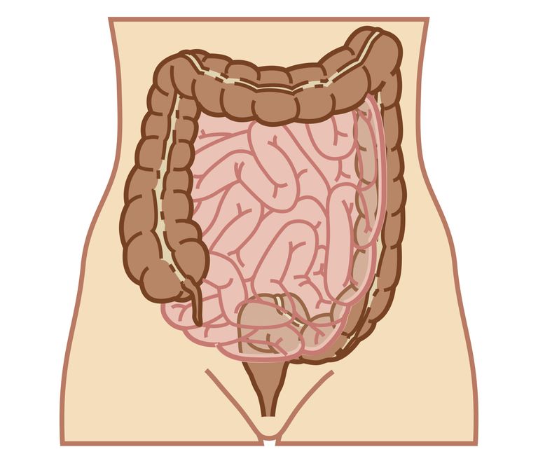 debelog crijeva, komplikacija IBD-a, može biti, nekim slučajevima, bolesti nego