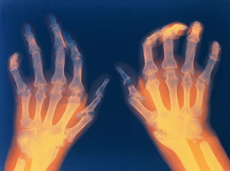 reumatoidnog artritisa, reumatoidnim artritisom, agresivno liječenje, oštećenja zglobova, oštećenje zglobova