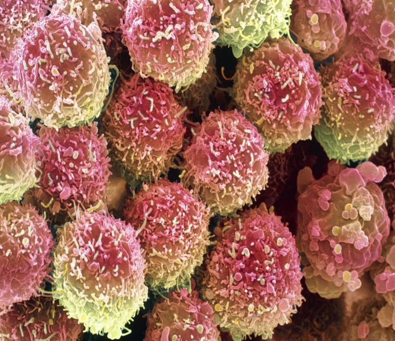 raka pluća, HPV-a raka, HPV-a raka pluća, povezani HPV-om, vrata maternice