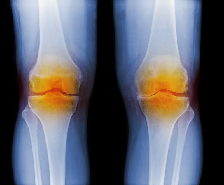oštećenja zglobova, aktivnosti bolesti, reumatoidnog artritisa, molekularnoj razini, oštećenje zglobova