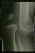 dislokacije koljena, nakon dislokacije, nakon dislokacije koljena, Dislokacija koljena, javlja kada