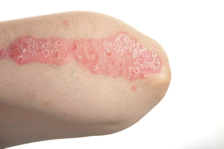 Koebnerov fenomen, može biti, može utjecati, Atopijski dermatitis, kože može, lihen planus