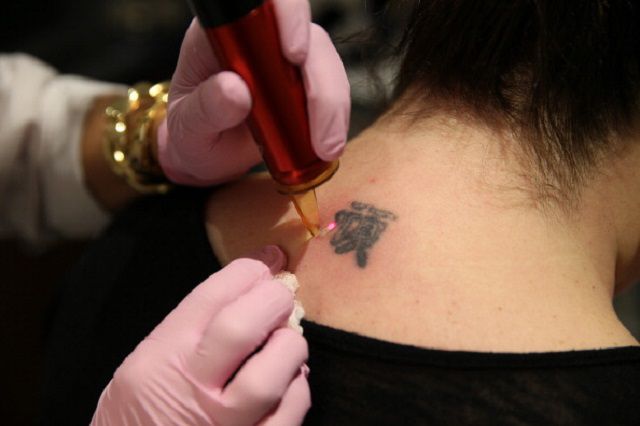 uklanjanje tetovaža, uklanjanja tetovaža, druge metode, lasersko uklanjanje