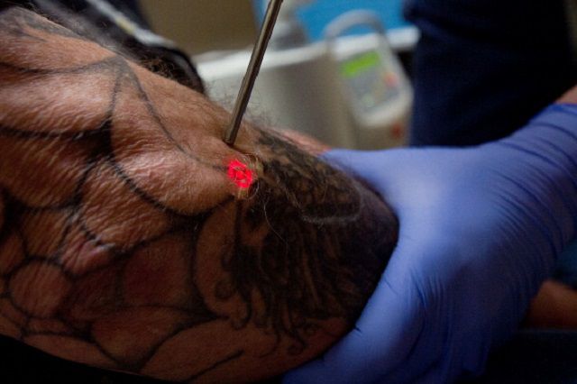 uklanjanje tetovaža, uklanjanja tetovaža, druge metode, lasersko uklanjanje
