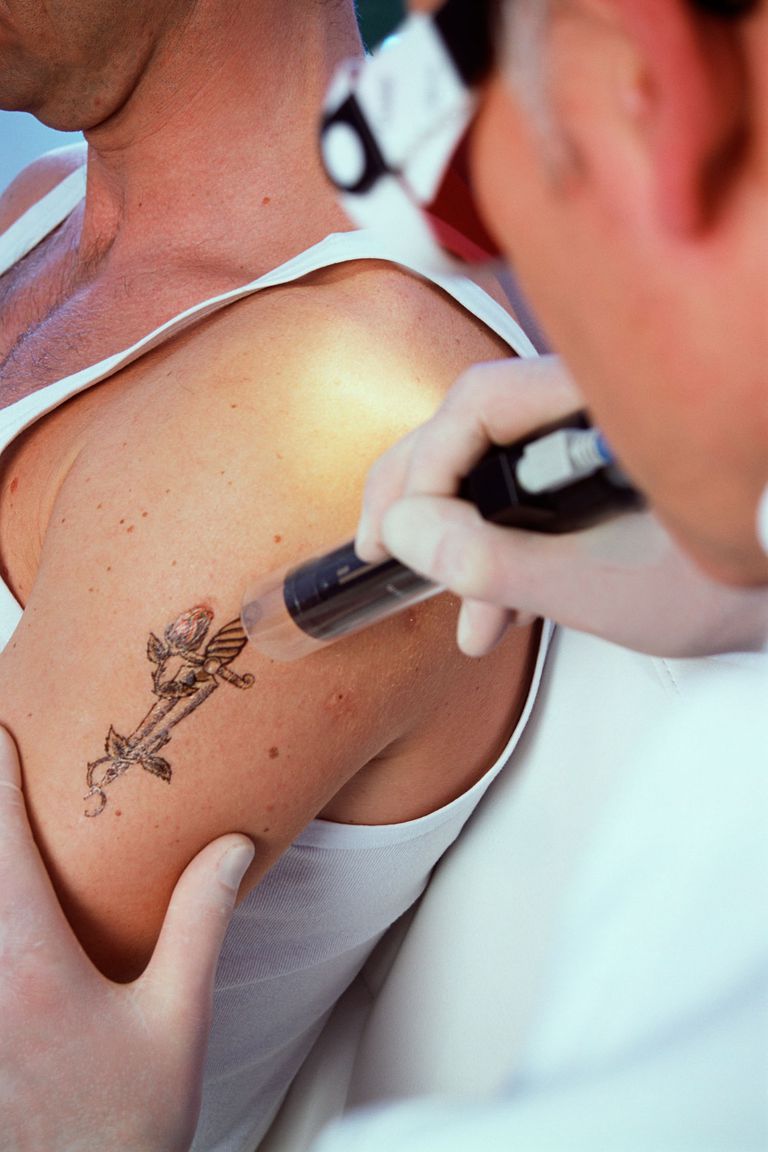 uklanjanje tetovaža, šest tjedana, uklanjanju tetovaža
