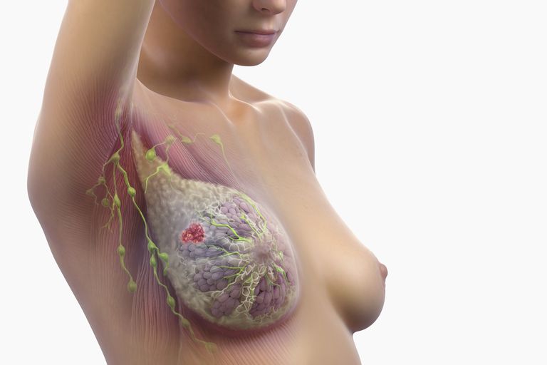 limfnih čvorova, limfnog čvora, Status limfnog čvora, unutar dojke