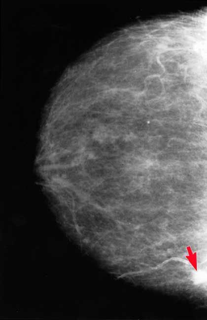 raka dojke, tkiva dojke, tkivo dojke, gusto tkivo, tkivu dojke, ultrazvuk dojke