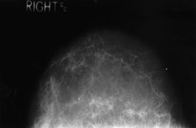 raka dojke, tkiva dojke, tkivo dojke, gusto tkivo, tkivu dojke, ultrazvuk dojke