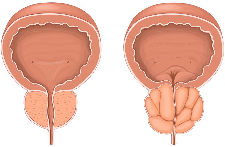 Rezūm® sustav, hipertrofija prostate, invazivni postupci, isprazniti mjehur