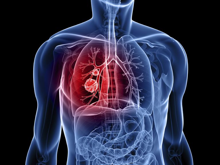 raka pluća, ne-malih stanica, stanica raka, stanica raka pluća, pluća ne-malih, pluća ne-malih stanica