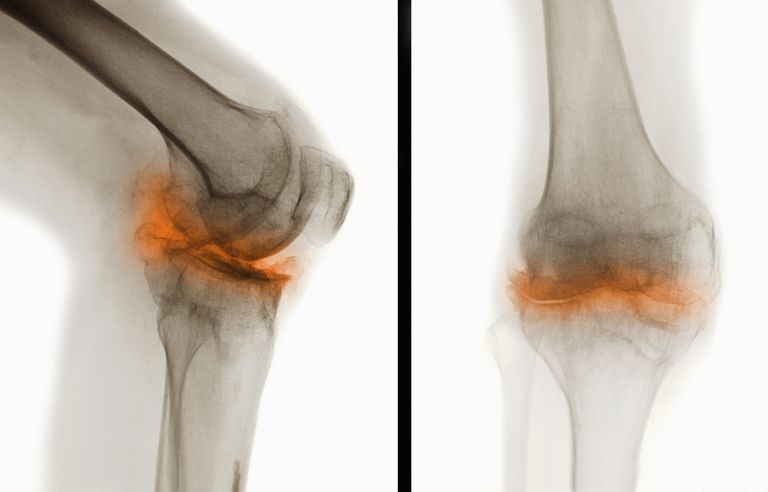 Reumatoidni artritis, trebate znati, koja zamjenjuje, koljeno osteoartritis, može uzrokovati