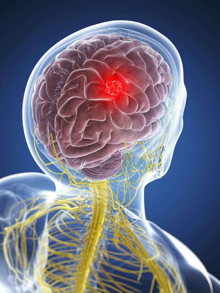 tumora mozga, može uzrokovati, drugi simptomi, glavobolje tumora
