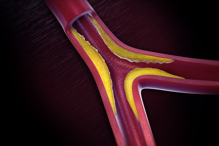 arteriji nogu, često znači, dijagnosticiranje PAD-a, krvni tlak, mogu doživjeti