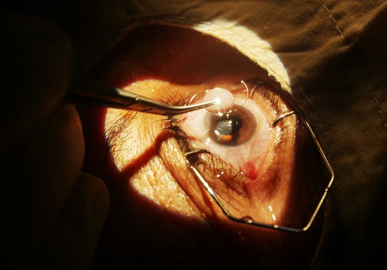 debele teške, intraokularne leće, leće Objektiv, lokalnom anestezijom