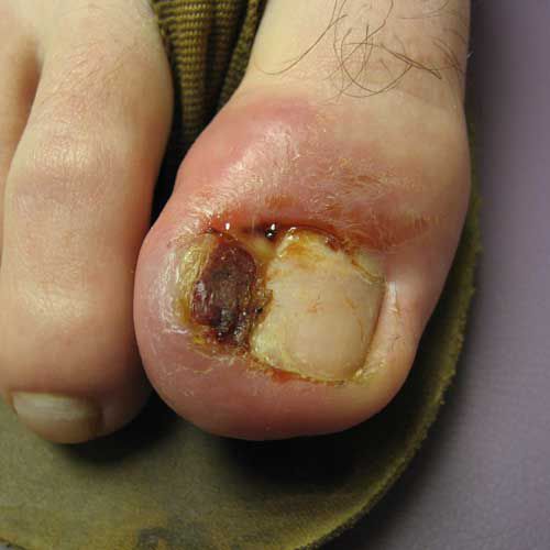 herpes simplex, između prstiju, bolest koja, dobije osip, gljivična infekcija, hladnih čireva