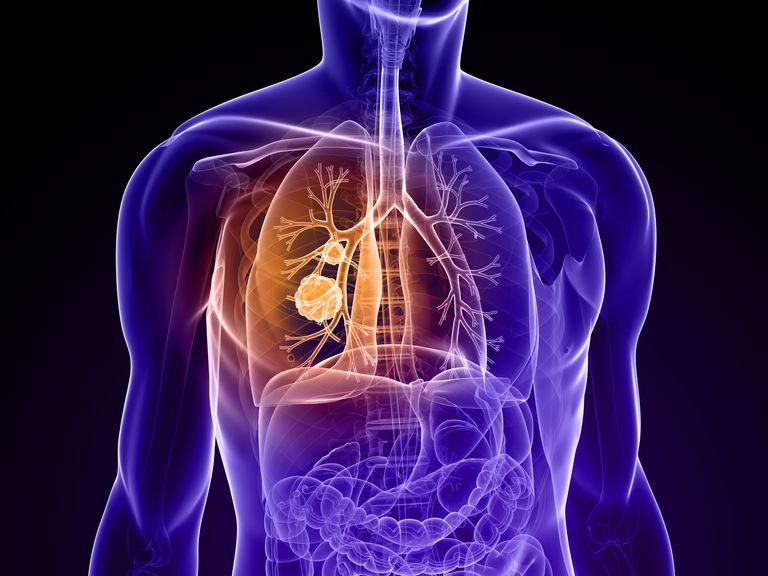 raka pluća, plućna masa, plućne mase, plućnu masu, karcinom pluća